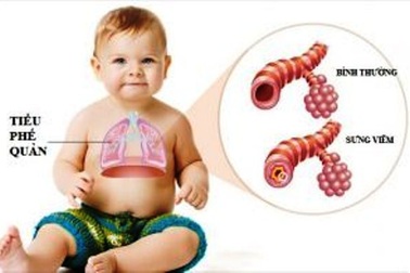 Viêm tiểu phế quản không chữa kịp thời dễ gây suy hô hấp, trẻ tử vong