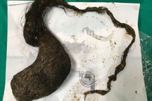 Thanh Hóa: Búi tóc nặng 1kg trong dạ dày bé gái 11 tuổi