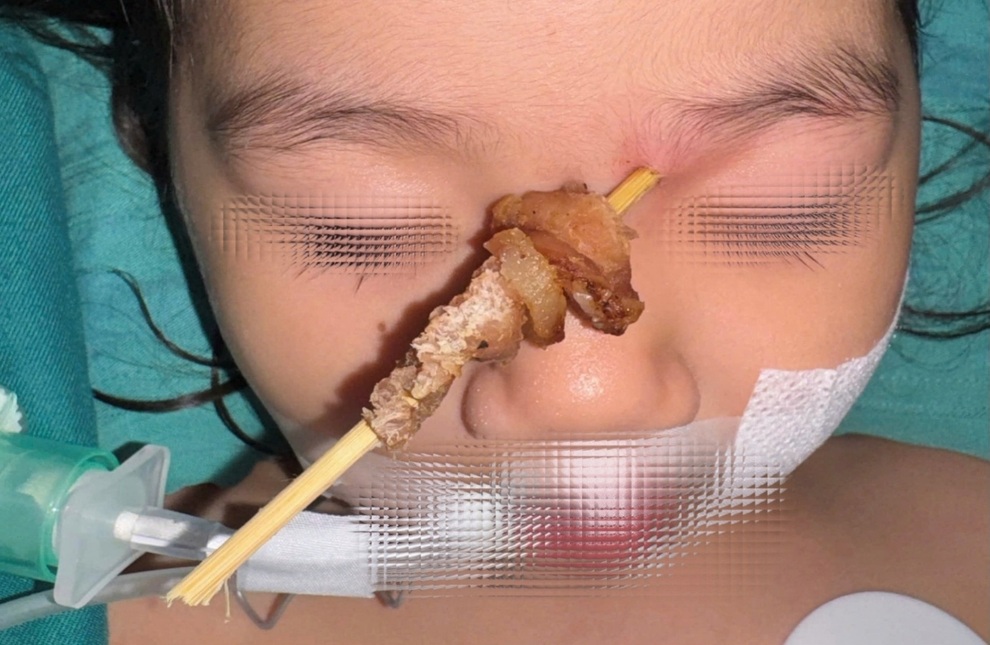 Bé gái 2,5 tuổi bị que xiên thịt đâm xuyên hốc mắt - 1