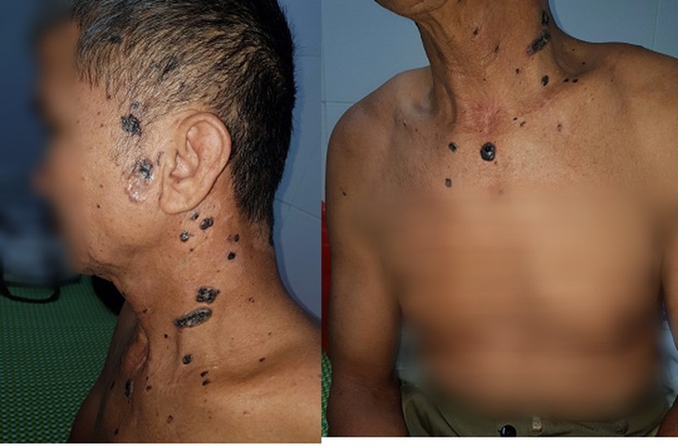 Người đàn ông mắc hội chứng đa ung thư da liên quan tới di truyền - 1 Người đàn ông mắc hội chứng đa ung thư da liên quan tới di truyền - 1