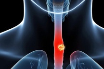 Triệu chứng ung thư thực quản giai đoạn cuối