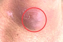 Ngã xe máy, người đàn ông 51 tuổi bị cây đâm sâu vào cổ