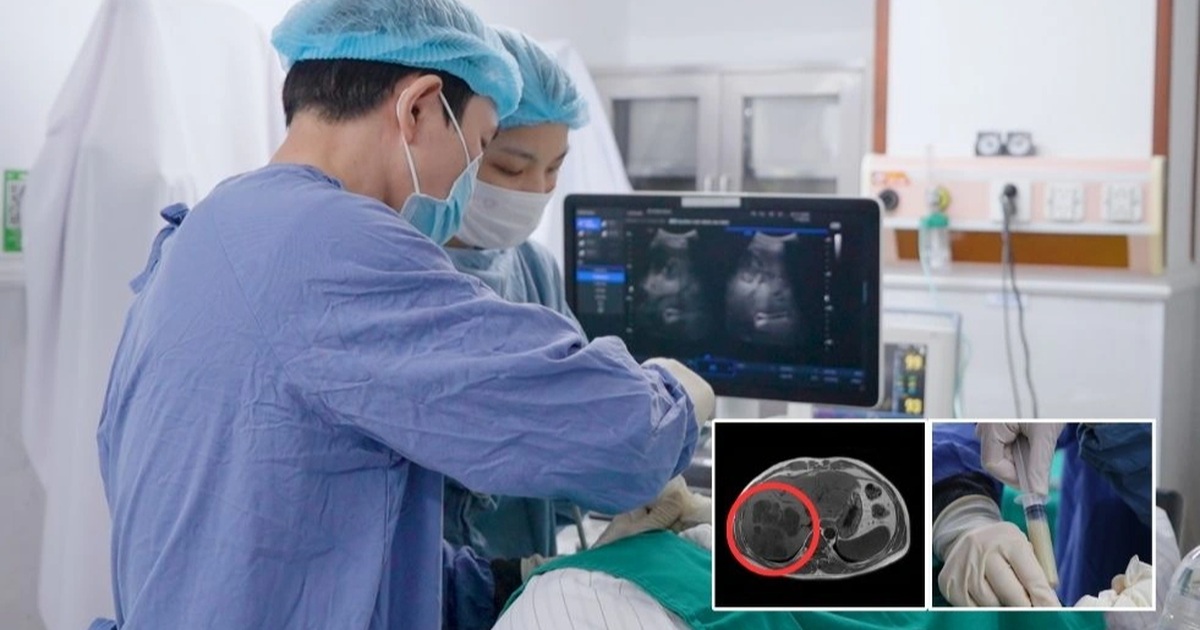 Nguy kịch vì chùm áp xe gan 11cm gây nhiễm khuẩn huyết