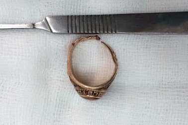 Nhập viện vì đeo nhẫn vào “súng”