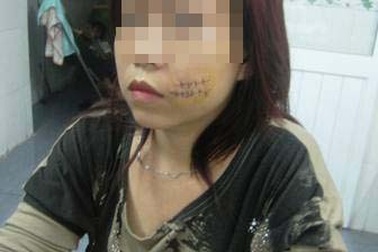 Nghi án một thiếu nữ bị rạch mặt vì tình