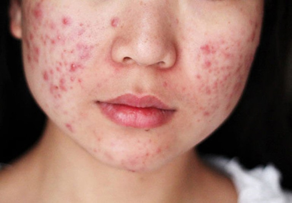 Nhìn thấy đồ ăn dầu mỡ là buồn nôn: Có thể gan đang gặp vấn đề - 2 Nhìn thấy đồ ăn dầu mỡ là buồn nôn: Có thể gan đang gặp vấn đề - 2