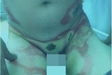 Cháy “súng” vì cất bật lửa trong túi quần