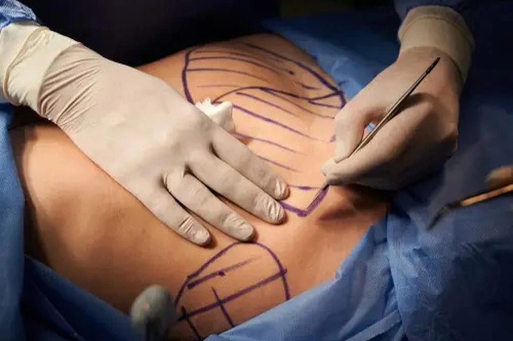 Nam giới chi hàng chục nghìn USD dao kéo để có cơ bụng 6 múi - 1 Nam giới chi hàng chục nghìn USD dao kéo để có cơ bụng 6 múi - 1
