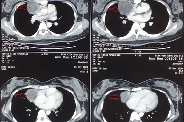 Cô gái trẻ bị u quái âm thầm "gặm nhấm" trung thất