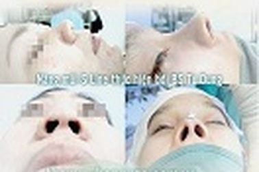 Nâng mũi chức năng kiểu cấu trúc kiểu Hàn Quốc