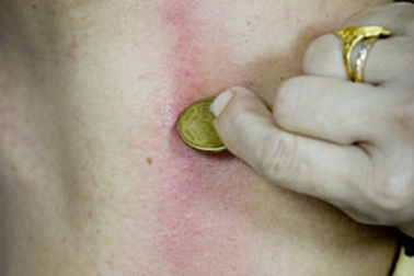 Cạo gió đúng cách!