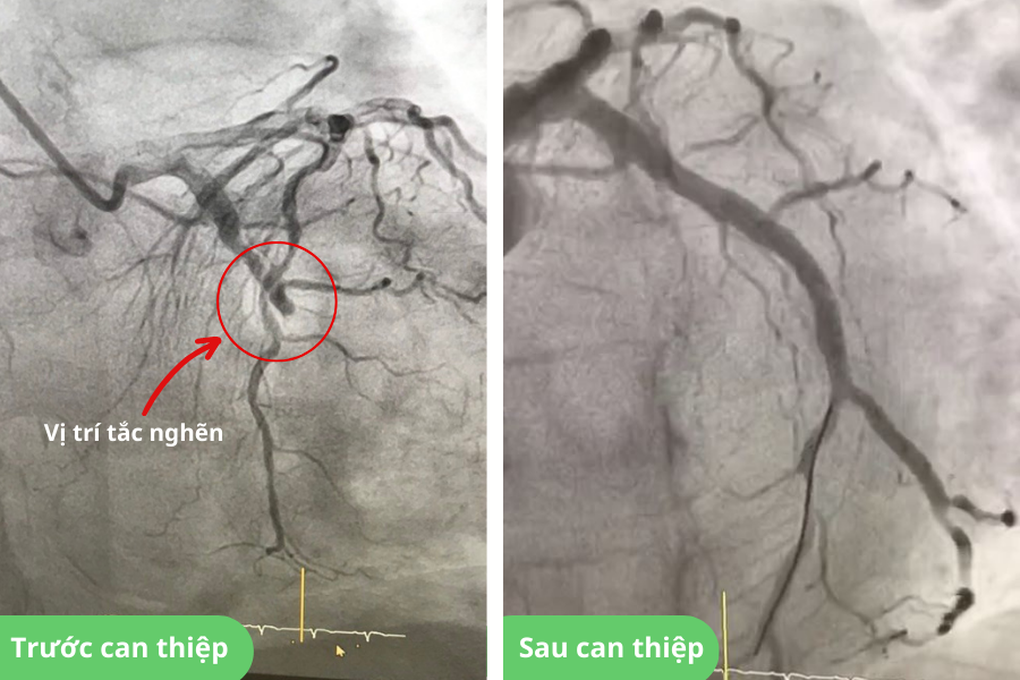 Đặt stent động mạch vành, cứu sống khách du lịch nhồi máu cơ tim cấp trong đêm - 2 Đặt stent động mạch vành, cứu sống khách du lịch nhồi máu cơ tim cấp trong đêm - 2