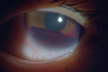 Tai nạn khi chơi bóng đá khiến nữ sinh 15 tuổi suýt mù mắt