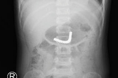 18 viên nam châm xếp hình trong ruột bé trai 3 tuổi