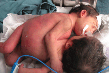 “Cặp song sinh dính nhau rất phức tạp”