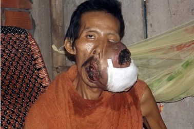 Người đàn ông bị khối u chiếm hết khuôn mặt không tiền điều trị