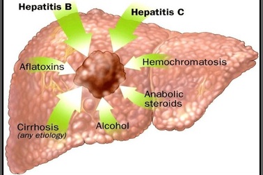 Ung thư biểu mô tế bào gan: Nguyên nhân, chẩn đoán và điều trị.