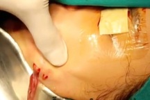 Sốc: Mù mắt, cắt bỏ tuyến vú, sẹo lồi lõm... vì tiêm filler làm đẹp