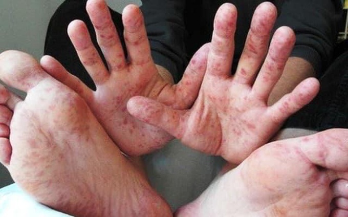 Sở Y tế lên tiếng trước thông tin hết thuốc Phenobarbital trong điều trị bệnh tay chân miệng ở trẻ em - Ảnh 2. Sở Y tế lên tiếng trước thông tin hết thuốc Phenobarbital trong điều trị bệnh tay chân miệng ở trẻ em - Ảnh 2.