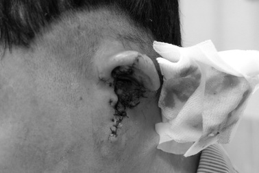 Tông vào bãi cát, nam thanh niên mất gần hết vành tai