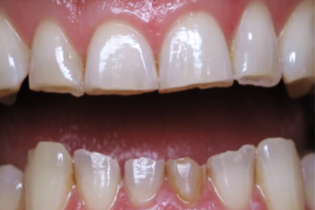 Cha mẹ cảnh giác con nghiến răng vì stress: Có thể gây biến dạng khuôn mặt - 1