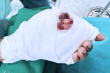 Đi cắt mì phụ giúp gia đình, bé trai 12 tuổi bị đứt hai ngón tay thương tâm