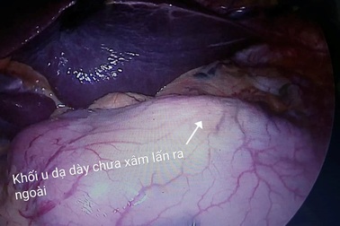 Phát hiện ca ung thư dạ dày sớm