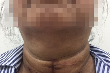 Bị chèn ép, khó thở vì bị u tuyến giáp khổng lồ 15 năm