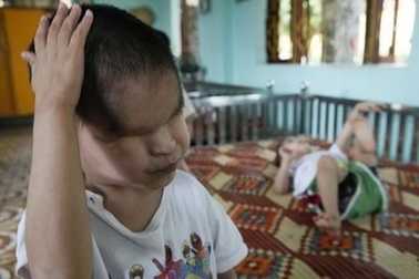 Hơn 11.000 người khuyết tật, nạn nhân da cam được khám sàng lọc