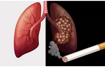 90% người bệnh mắc loại ung thư gây tử vong hàng đầu liên quan đến thuốc lá