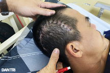 Bi kịch nhậu nhẹt lái xe: Mổ não sau tiệc cưới, ngã quỵ vì tông chết người