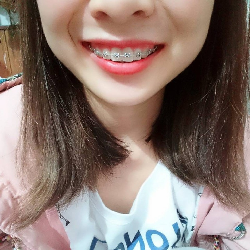Đi niềng răng, tôi bị người yêu đề nghị chia tay - 1 Đi niềng răng, tôi bị người yêu đề nghị chia tay - 1