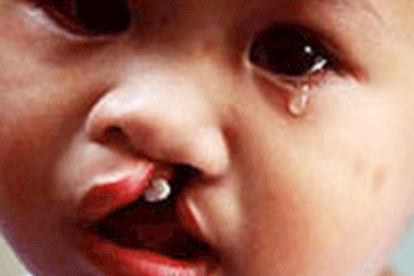 Phẫu thuật miễn phí cho trẻ khuyết tật khe hở môi - vòm miệng