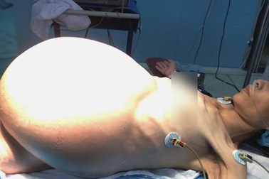 Đại phẫu bóc khối bướu khổng lồ nặng tới 19kg