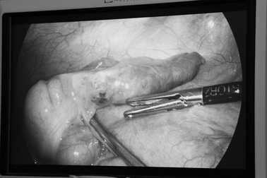 Hi hữu đang mổ ruột thừa gắp ngay dị vật xương cá đâm xuyên thành ruột