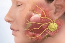 Phân biệt ung thư vòm họng với bệnh lý vùng mũi họng