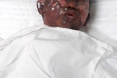 Bé trai bị dì ruột tẩm xăng thiêu sống bỏng 50% cơ thể