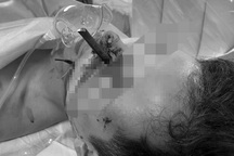 Thanh niên vào viện cấp cứu với thanh sắt dài 12cm cắm xuyên mặt