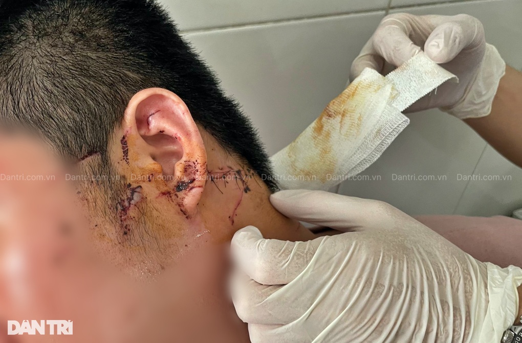 Lời kể ám ảnh của nạn nhân nghi bị cướp cứa cổ khi đi tắm biển Phú Quốc - 1 Lời kể ám ảnh của nạn nhân nghi bị cướp cứa cổ khi đi tắm biển Phú Quốc - 1