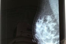 Thực hư thông tin nâng ngực gây ung thư