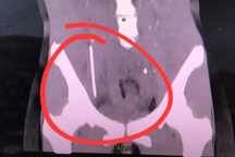 Giật mình khi cha gọi, bé gái 13 tuổi nuốt chửng que kẹo suýt thủng ruột