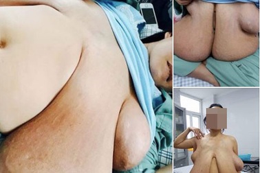 Hiếm gặp ca ngực “khủng” và dài tới quá bẹn