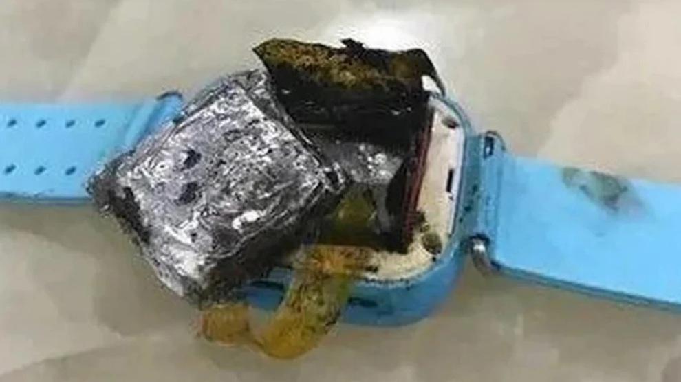 Bé gái 4 tuổi bị bỏng độ 3 vì smartwatch phát nổ trên tay - 1 Bé gái 4 tuổi bị bỏng độ 3 vì smartwatch phát nổ trên tay - 1