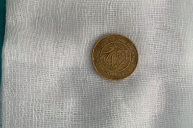 Nuốt đồng xu chơi game, bé trai 8 tuổi cấp cứu