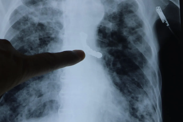 Cụ ông tắc đường thở  vì 9 chiếc răng giả chui tọt vào phế quản