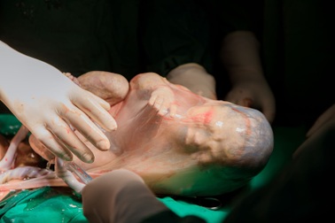 Hà Nội: Cặp song thai chào đời, 1 bé vẫn còn nguyên trong bọc ối