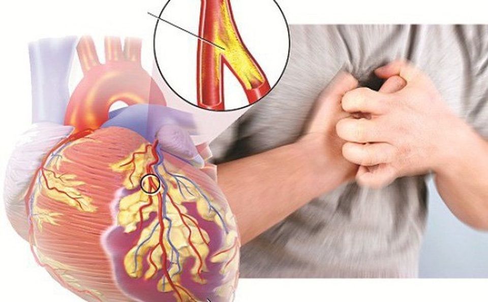 Mỹ cấp phép sử dụng thuốc tiểu đường trong điều trị suy tim - 1 Mỹ cấp phép sử dụng thuốc tiểu đường trong điều trị suy tim - 1