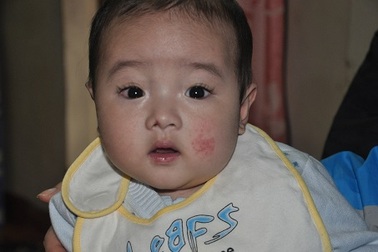 Bé Đức Duy đã được phẫu thuật tim thành công