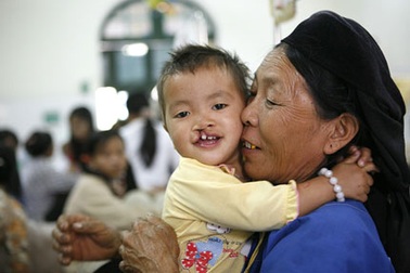 Phẫu thuật miễn phí cho bệnh nhân sứt môi, hở hàm ếch