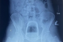 Nam thanh niên tự nhét cốc vào hậu môn, kẹt sâu phải mổ cấp cứu